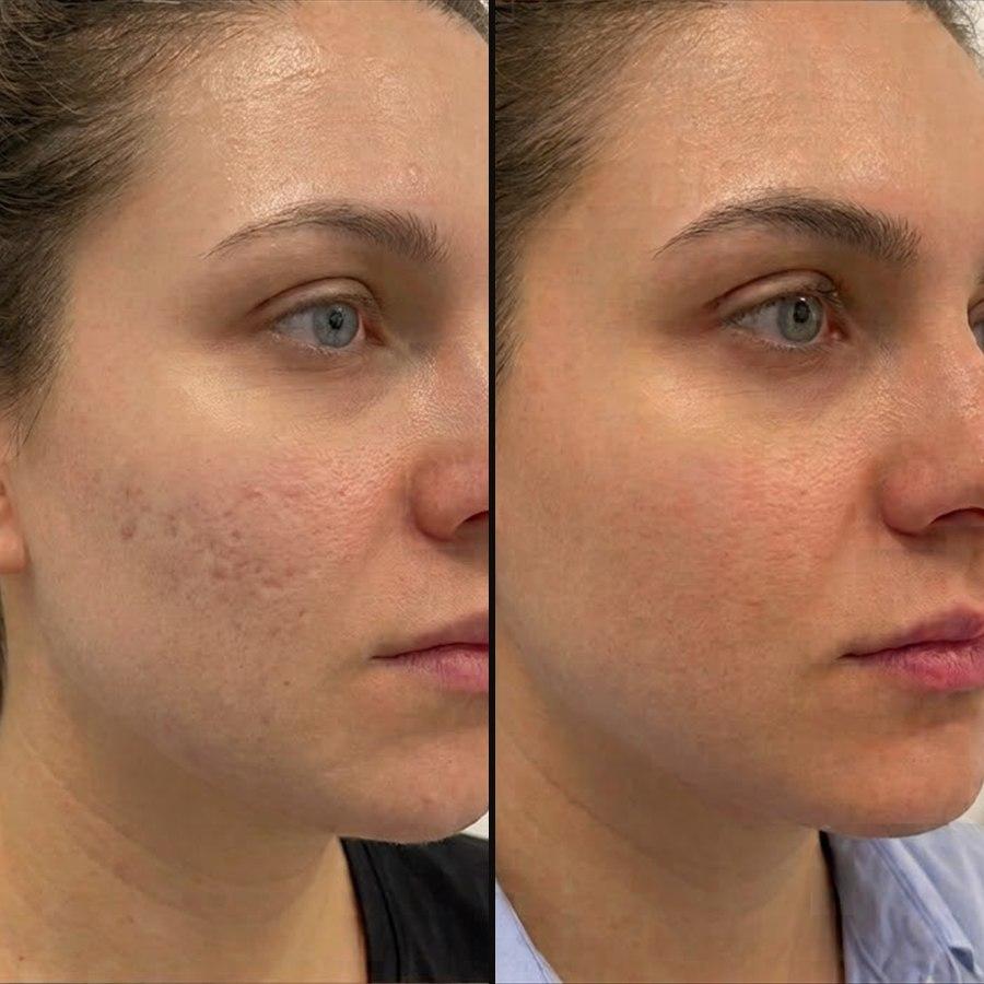 Tratament facial pentru textura pielii – înainte și după