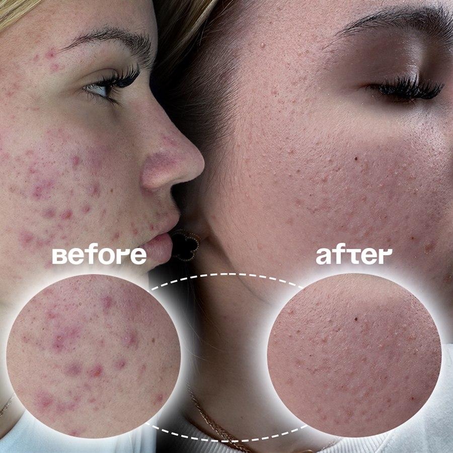 Tratament facial – piele înainte și după, Venus Studio Sibiu